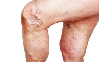 varicose veins and spiders