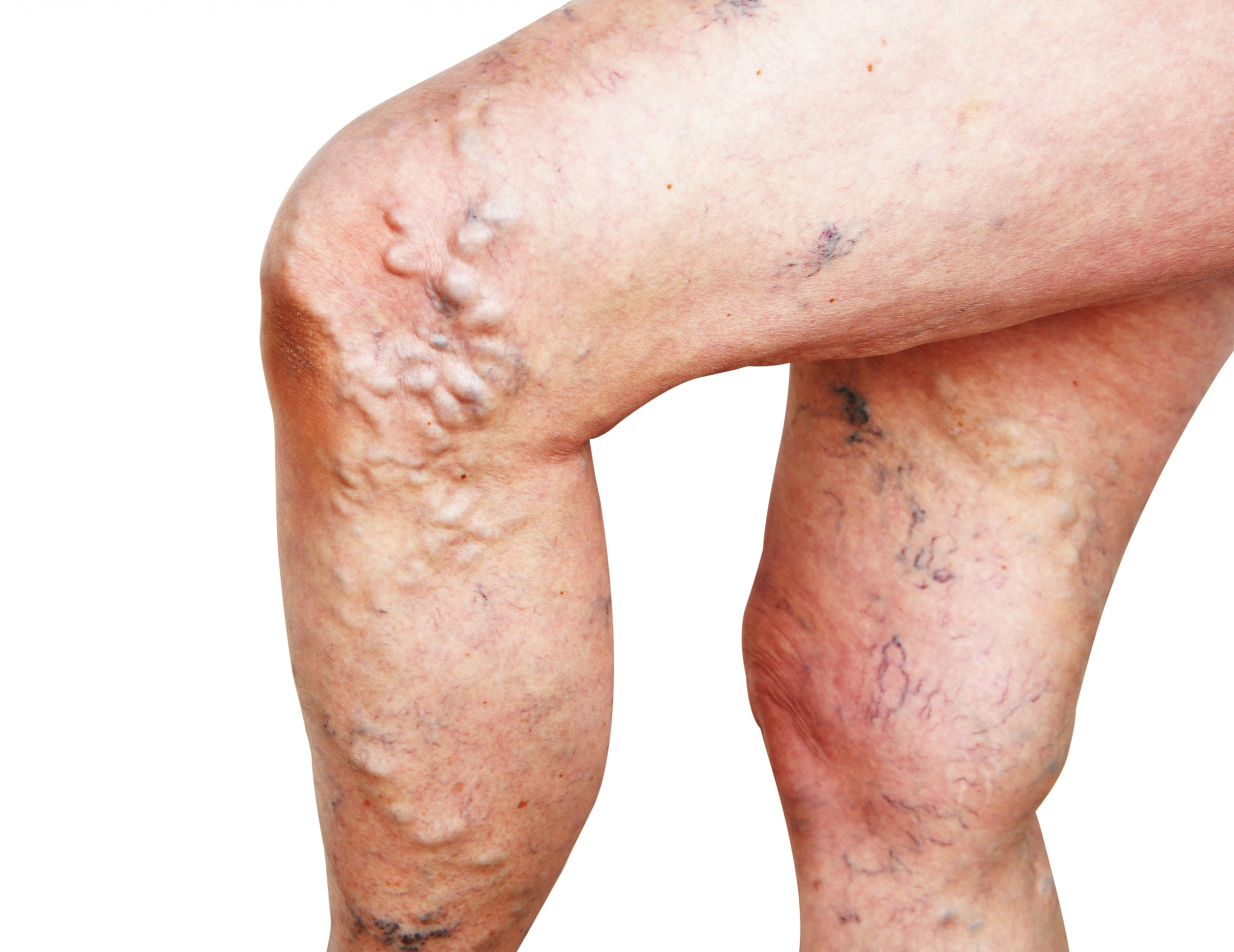 varicose veins and spiders