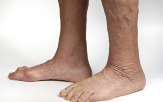 Ankles With Bleeding Varicose Veins