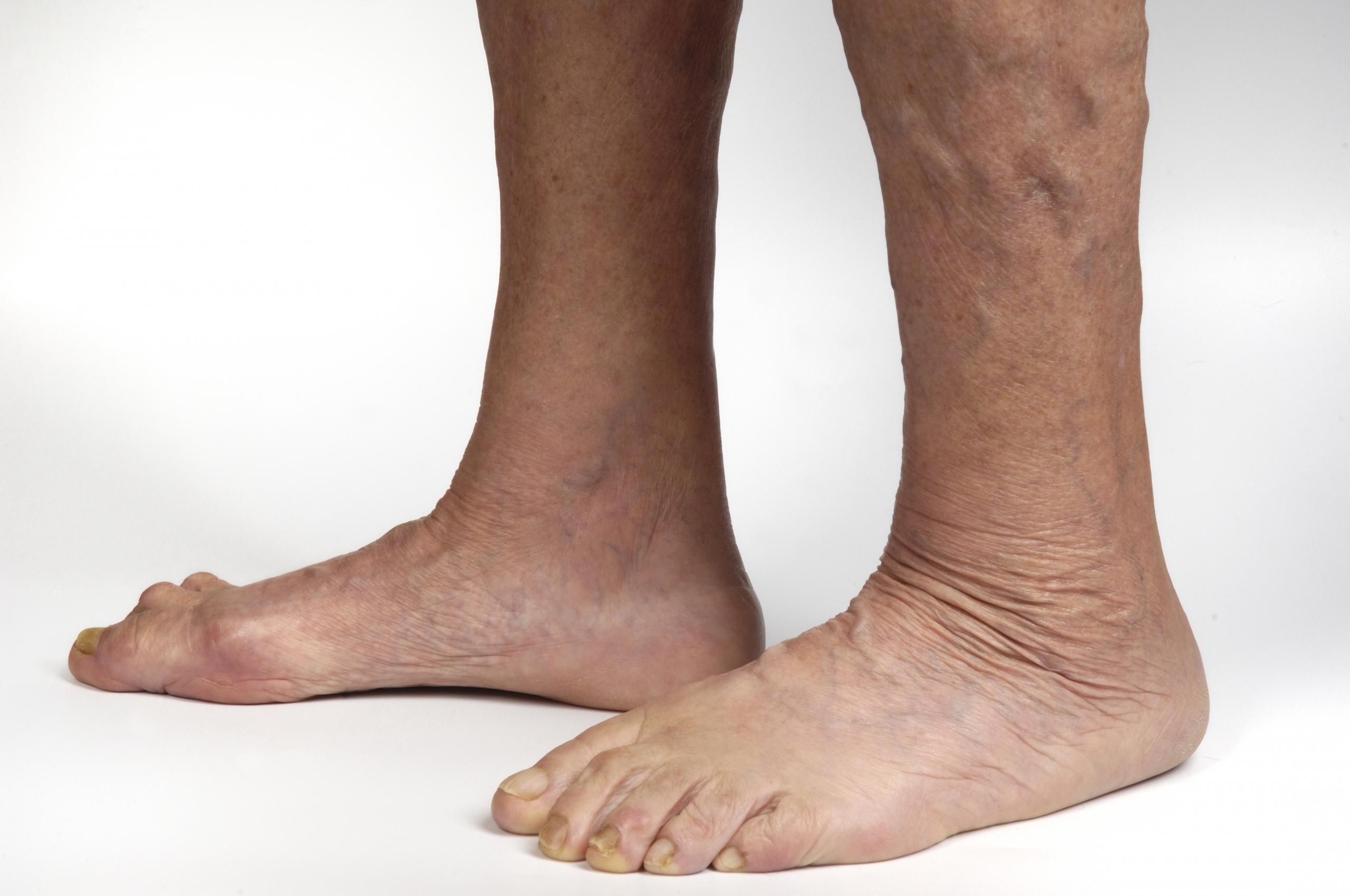 Ankles With Bleeding Varicose Veins