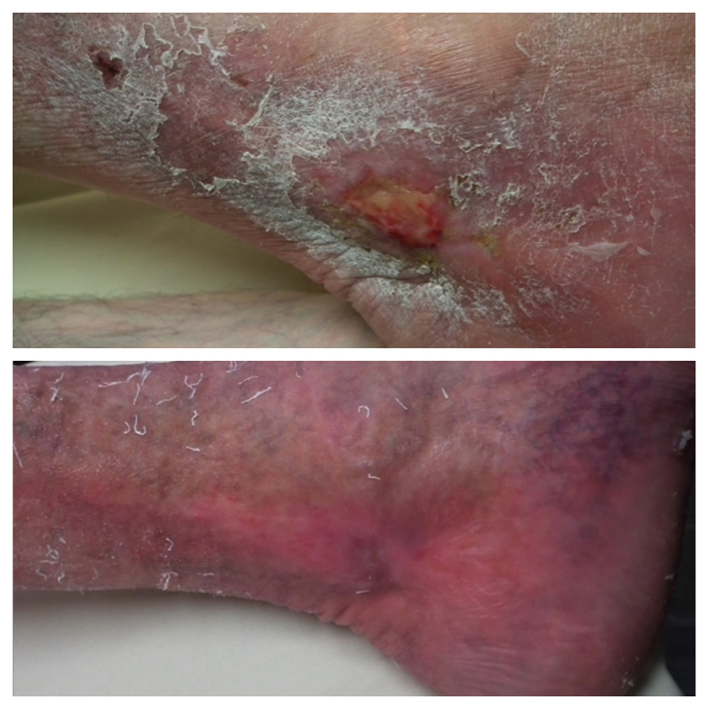 Complications of Untreated Varicose Veins #4: Leg Ulceration 2 ulcer-1_fotor