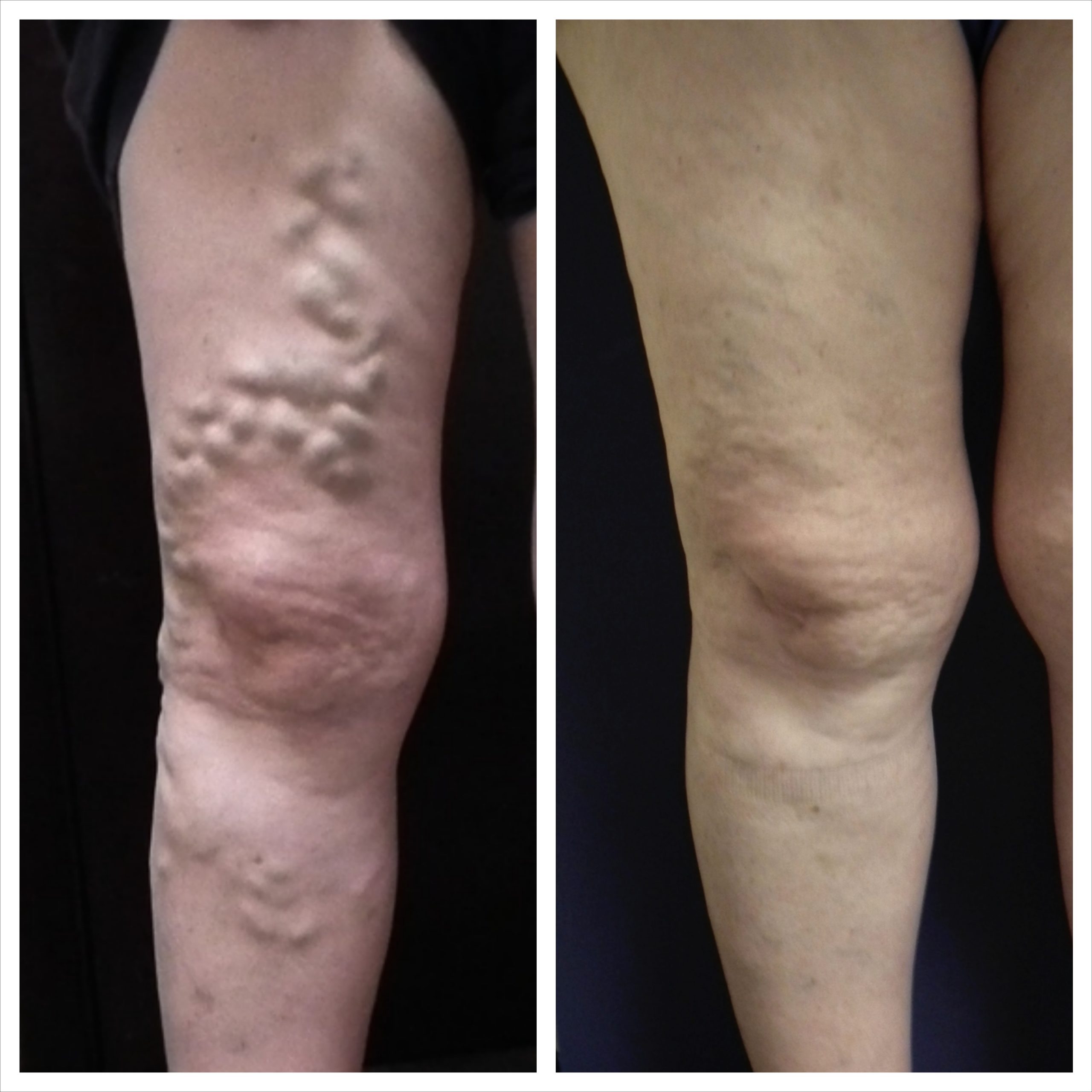 Before and After Varicose vein in upper thigh