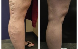 varicose vein before after