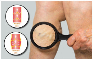 image magnifying glass on leg showing varicose vein along with diagram showing blood flow in normal and diseased vein