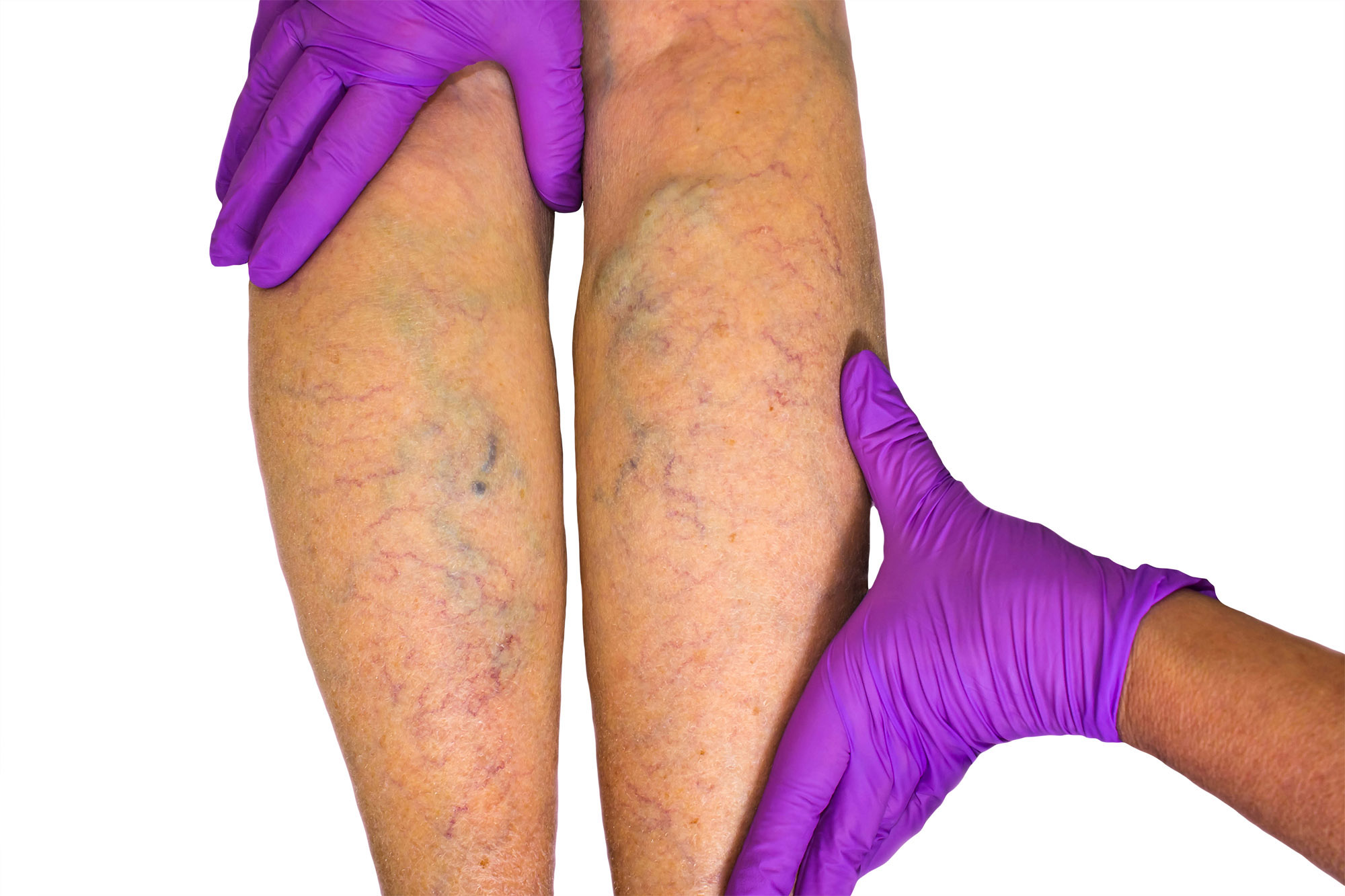 Capitol Vein & Laser Centers - Compression is essential for safe summer  travel! 📲If you have varicose veins, leg swelling or pain, it's time to  visit Capitol Vein and Laser Centers. Call