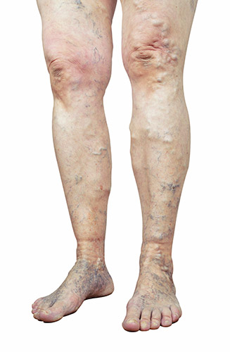 Complications of Untreated Varicose Veins #5: Swelling 3 Swollen Ankles
