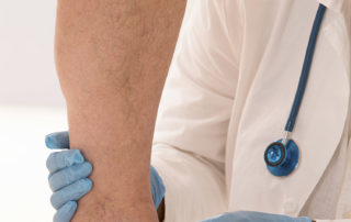 medi-cal varicose vein treatment san diego