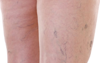 photo of spider veins on back of thighs