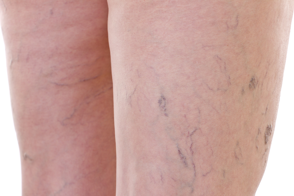 photo of spider veins on back of thighs