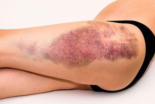 How to reduce bruising after vein surgery?