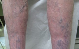 chronic vein disease