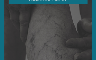 varicose vein