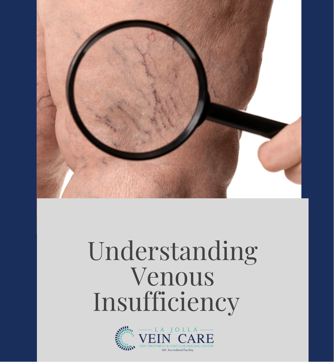 venous insufficiency