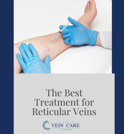 The best treatment for reticular veins