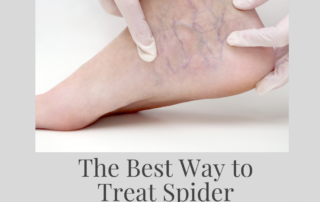 The best way to treat spider veins