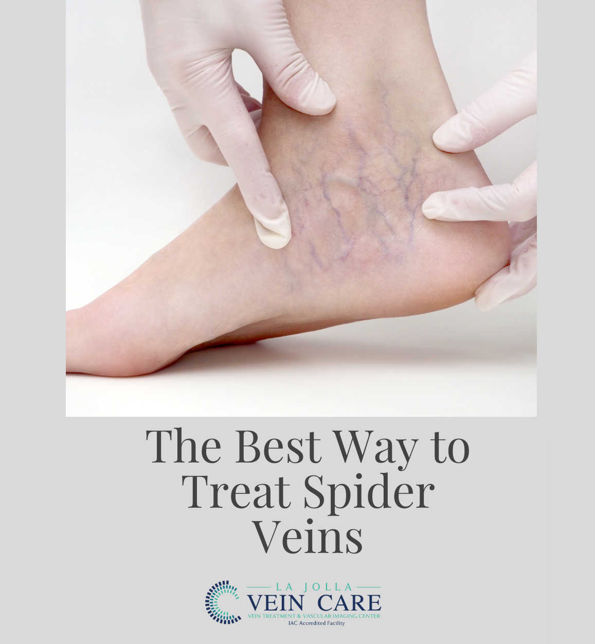 The best way to treat spider veins