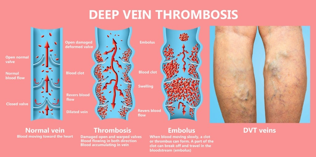 Deep Vein Thrombosis Diagnosis and Treatment San Diego