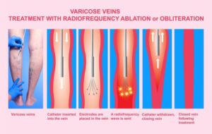 radiofrequency treatment for varicose veins
