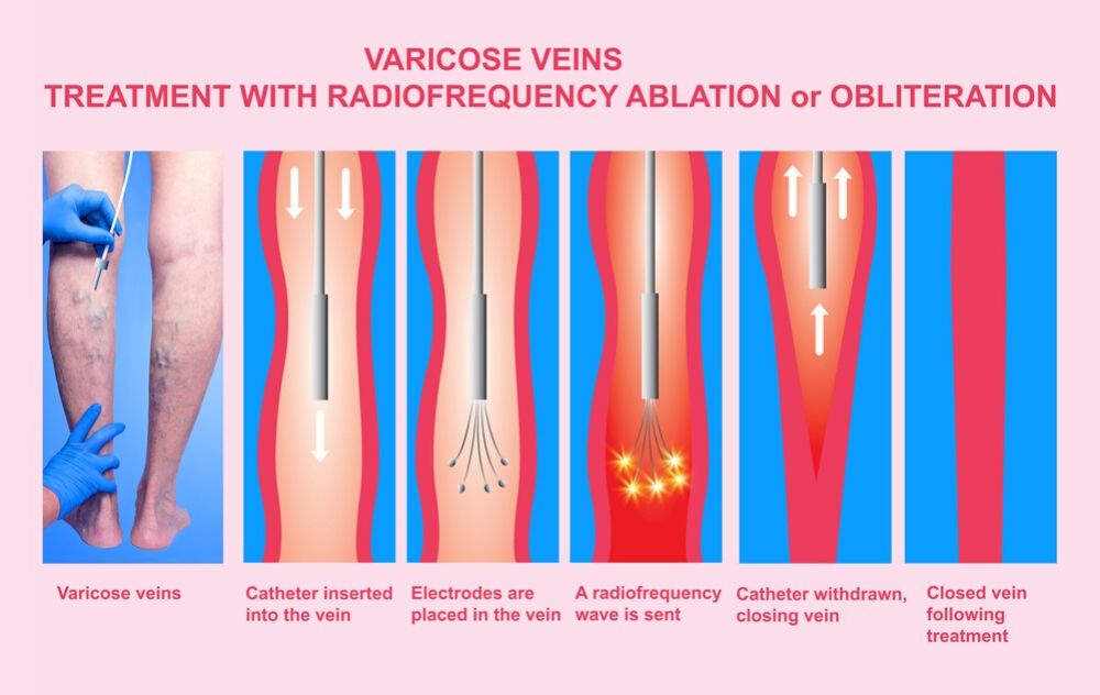 Radiofrequency Treatment For Varicose Veins