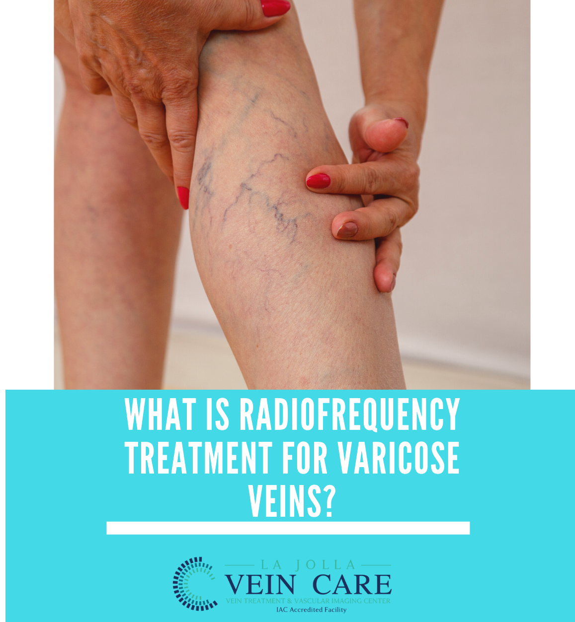 radiofrequencytreatment for varicose veins