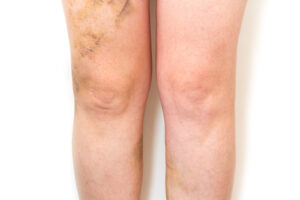 vein treatment bruise