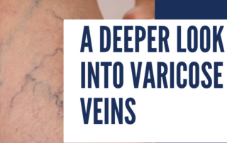 varicose veins