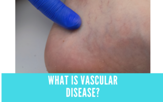 vascular disease