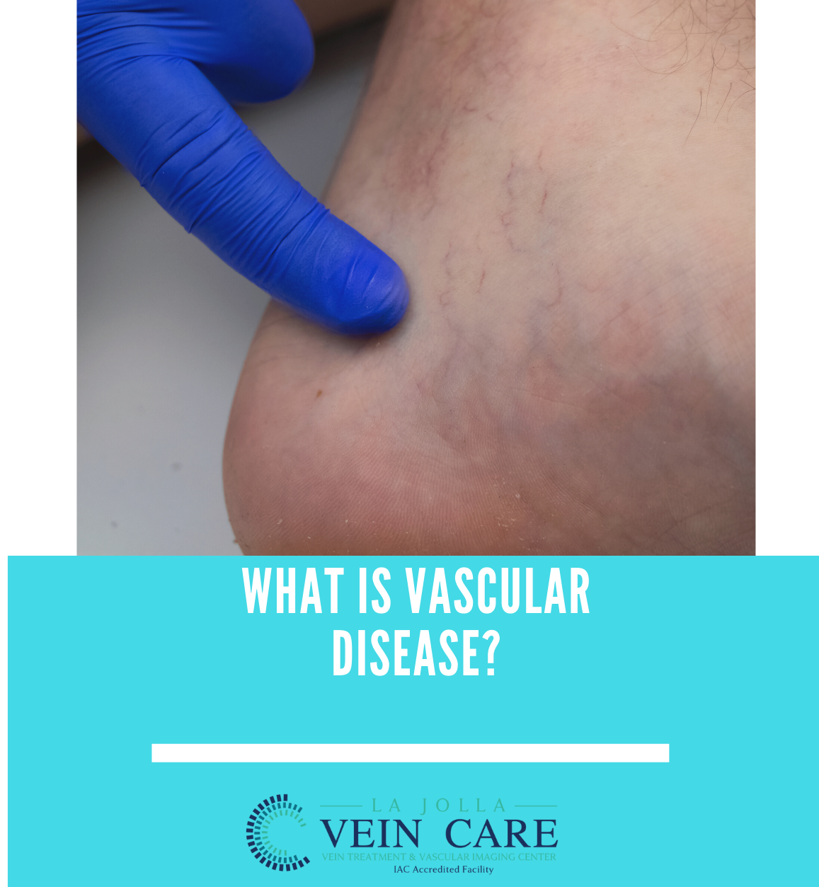 vascular disease