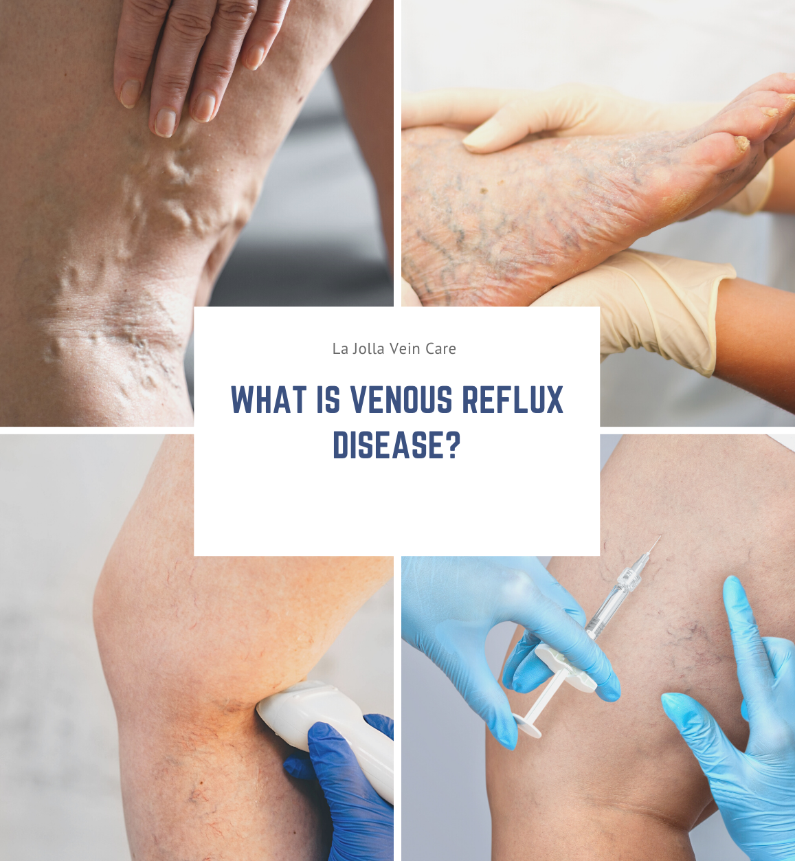 Venous Reflux Disease