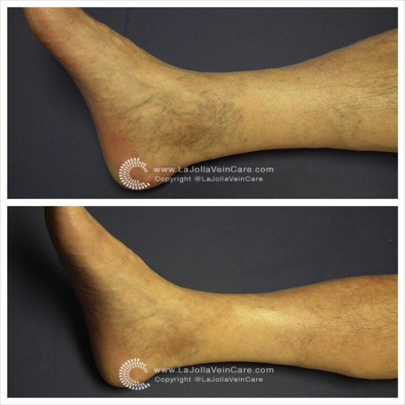 Spider Veins Before and After Patient Transformation