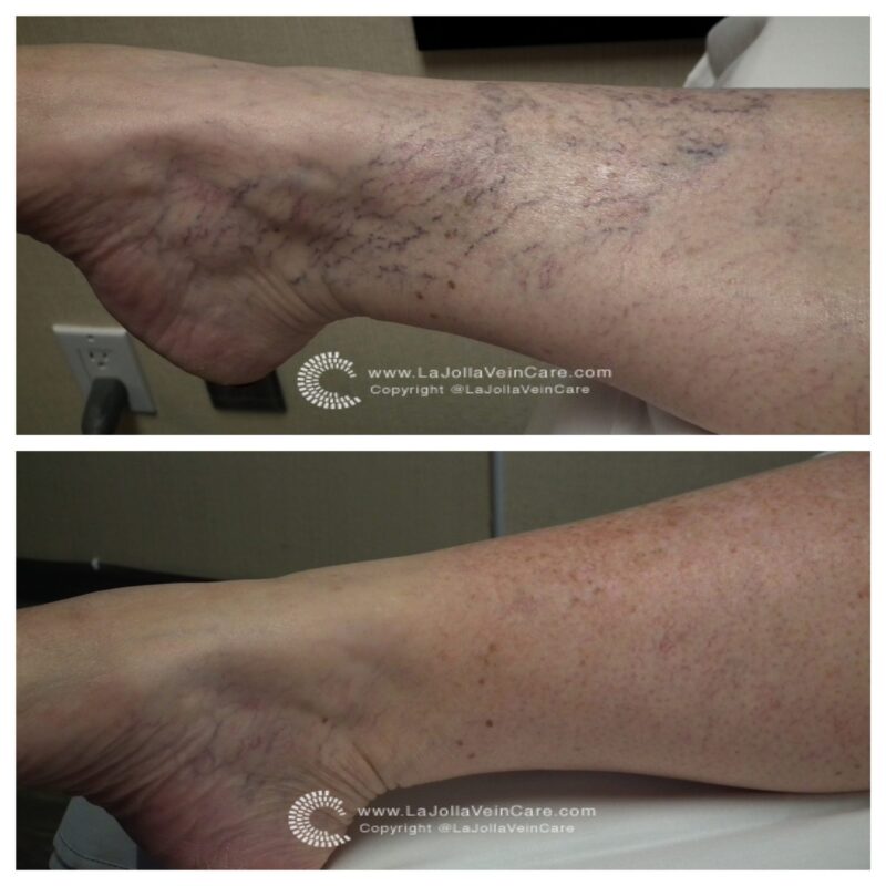 Spider Veins Before and After Patient Transformation