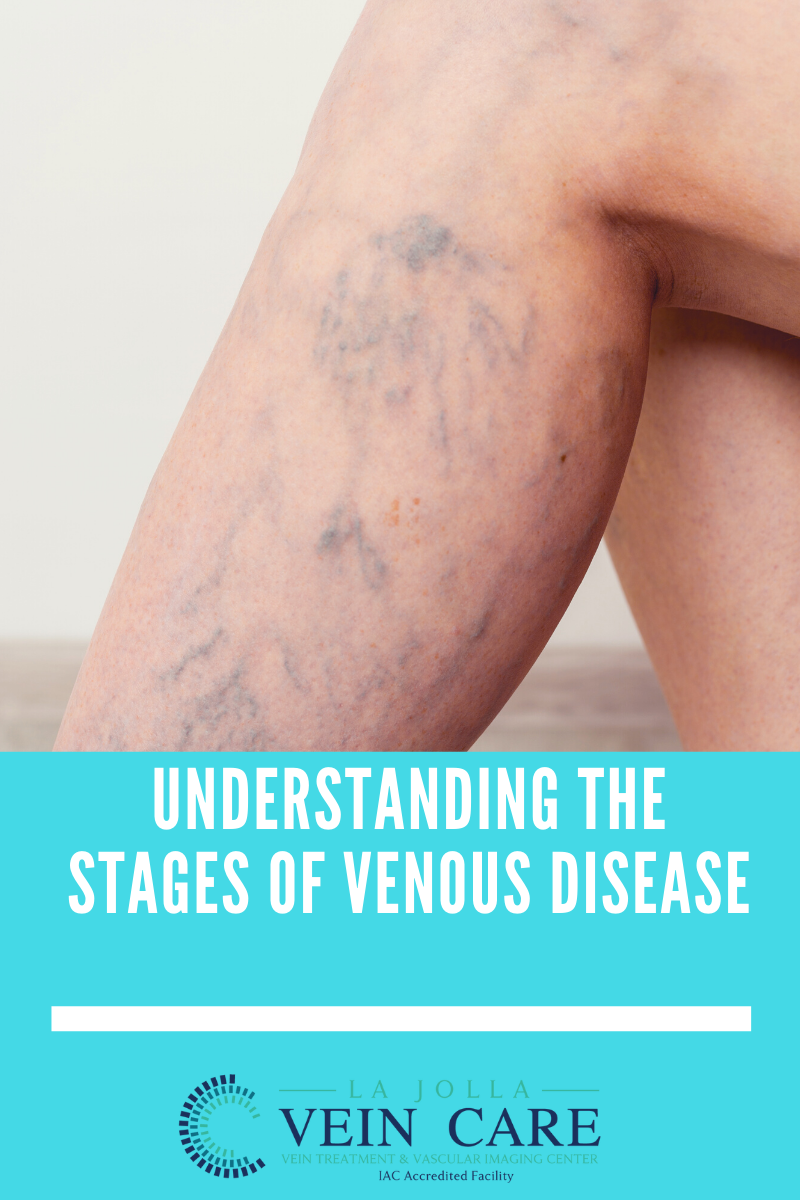 venous disease