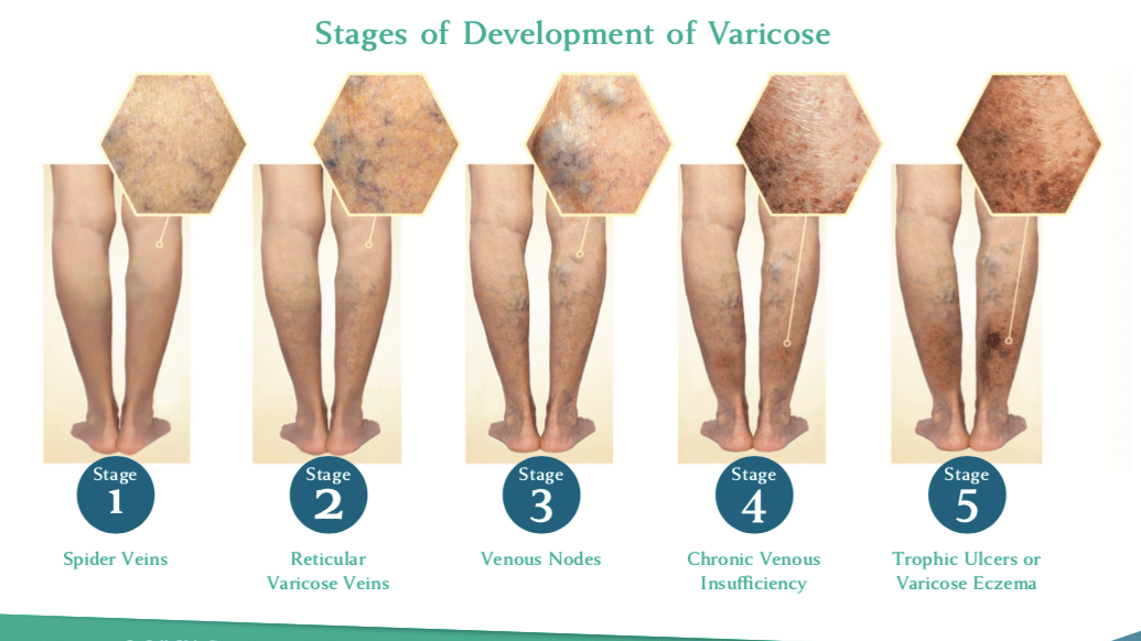 Stages of Development of Varicose | Trusted Vein & Vascular Treatments | La Jolla Vein 