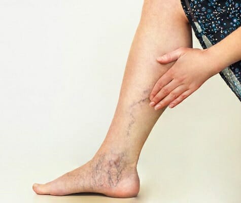What-is-venous-disease-sm