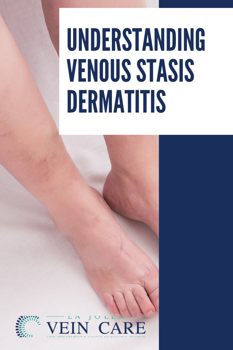 Venous Stasis Dermatitis