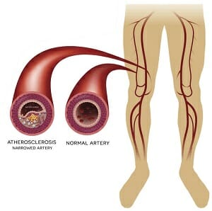 Arterial treatments sm