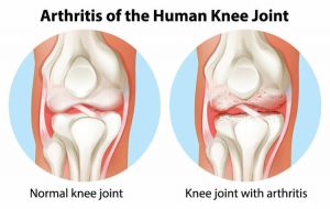 Arthritis-of-the-human-knee-joint-300×190