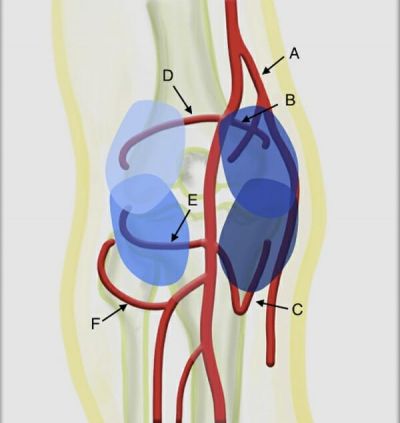 Genicular-artery-embolization-knee-400×423