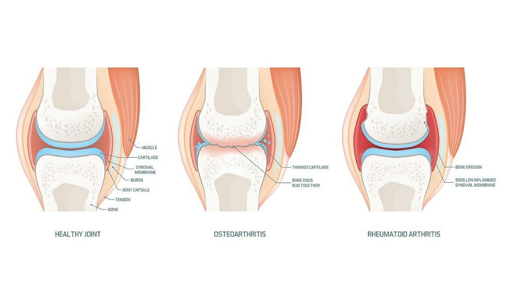 Joint Anatomy Osteoarthritis And Rheumatoid Arthritis Infographic 