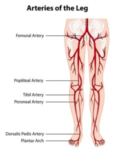 Peripheral arterial disease diagram 2 sm