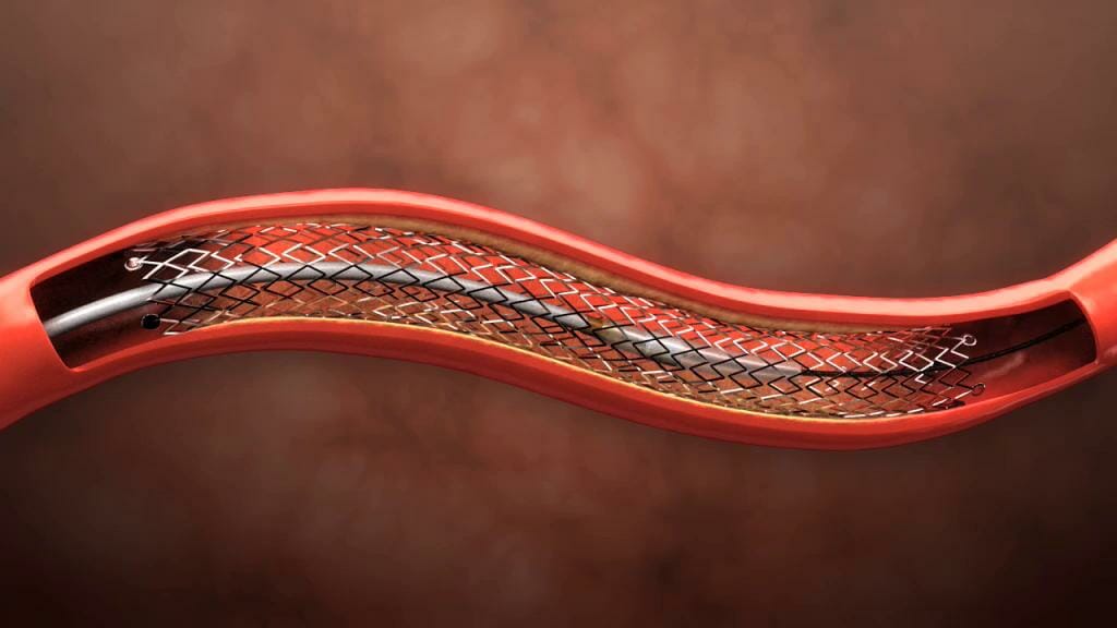 Stenting-treatments-video