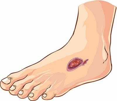 Vector illustration of a medical Diabetic foot