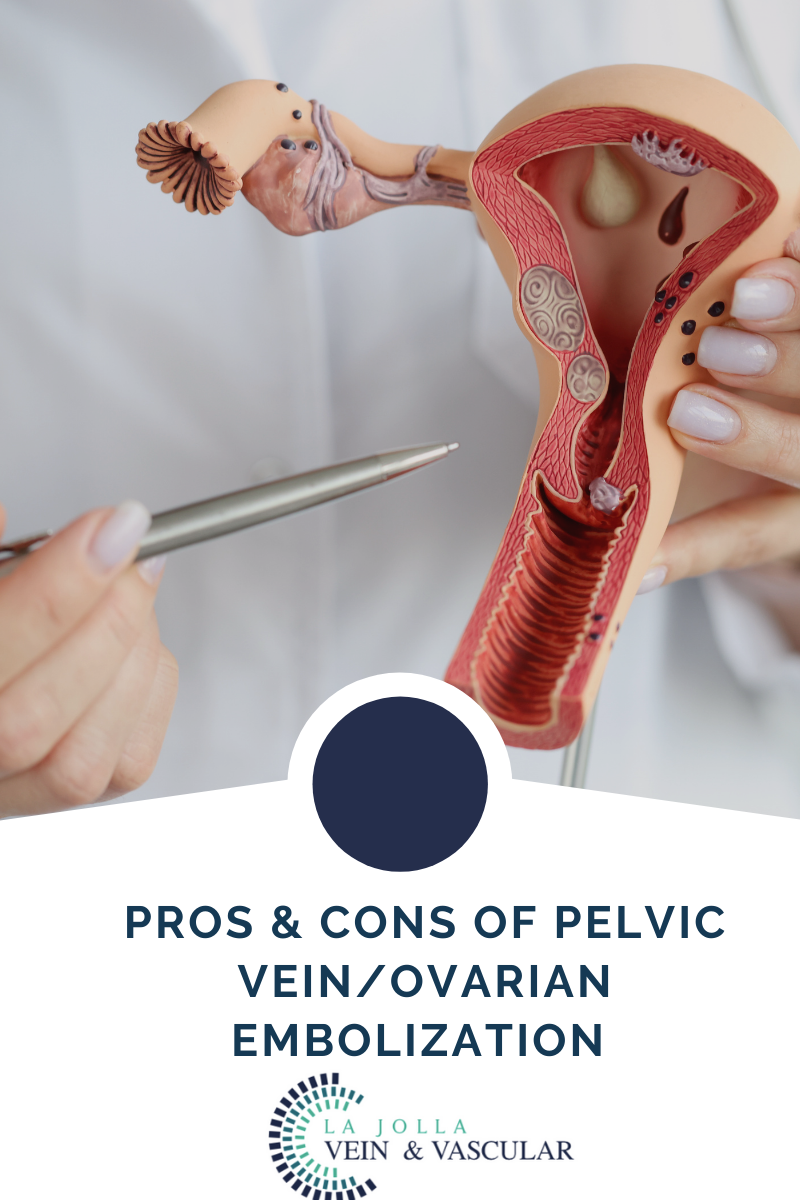 Pros and Cons of Pelvic Vein/Ovarian Embolization Procedure