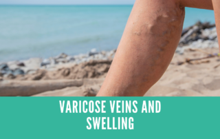 varicose veins