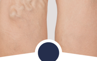 varicose veins