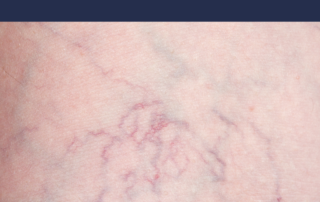 Spider Veins: Before & After Transformation 10 spidervein