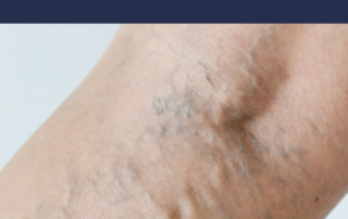 How to reduce bruising and swelling after vein treatment 9 bruising