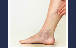 vein disease