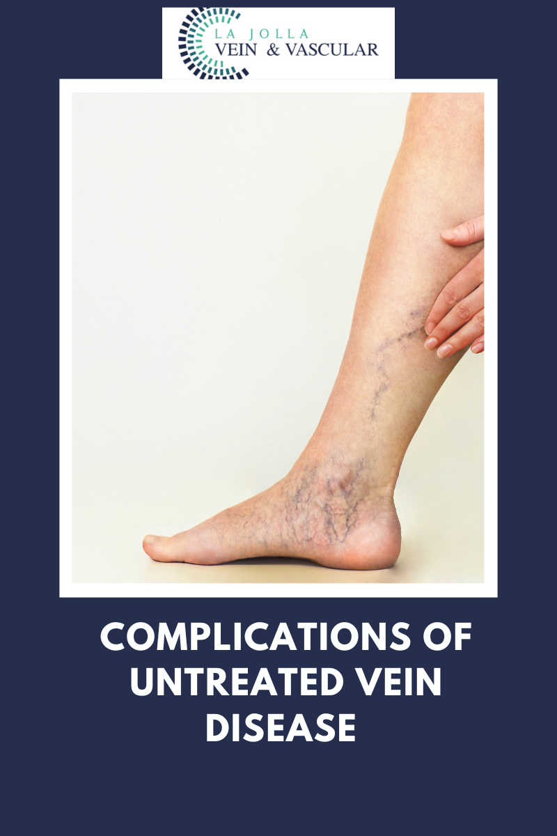 Ankle Discoloration: Causes and Treatment Options - Vein