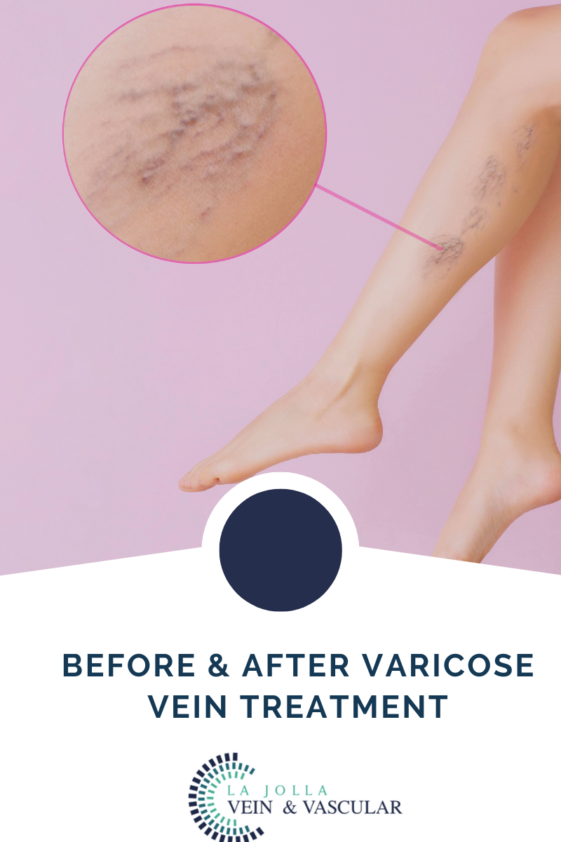Before & After Varicose Vein Treatment